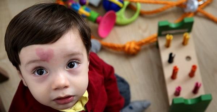 Un enfant né avec une marque de naissance en forme de cœur sur le front : à quoi ressemble-t-il aujourd'hui