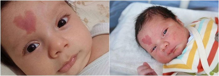 Un enfant né avec une marque de naissance en forme de cœur sur le front : à quoi ressemble-t-il aujourd'hui