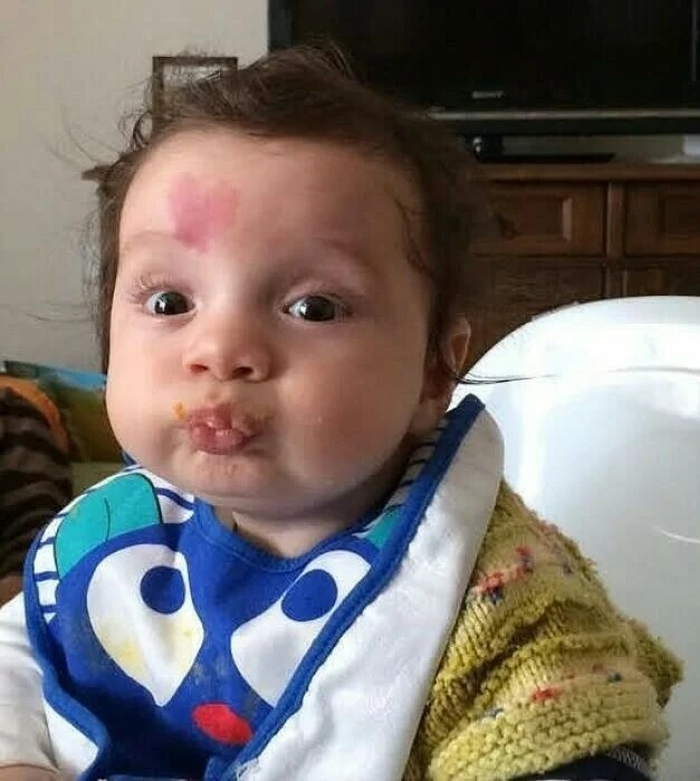 Un enfant né avec une marque de naissance en forme de cœur sur le front : à quoi ressemble-t-il aujourd'hui