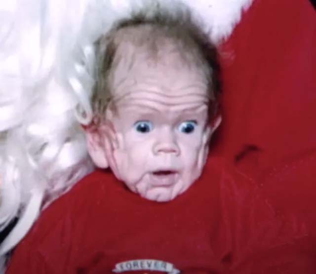 Ce garçon est né en 1993 avec une peau plissée comme celle d'un enfant de 5 ans