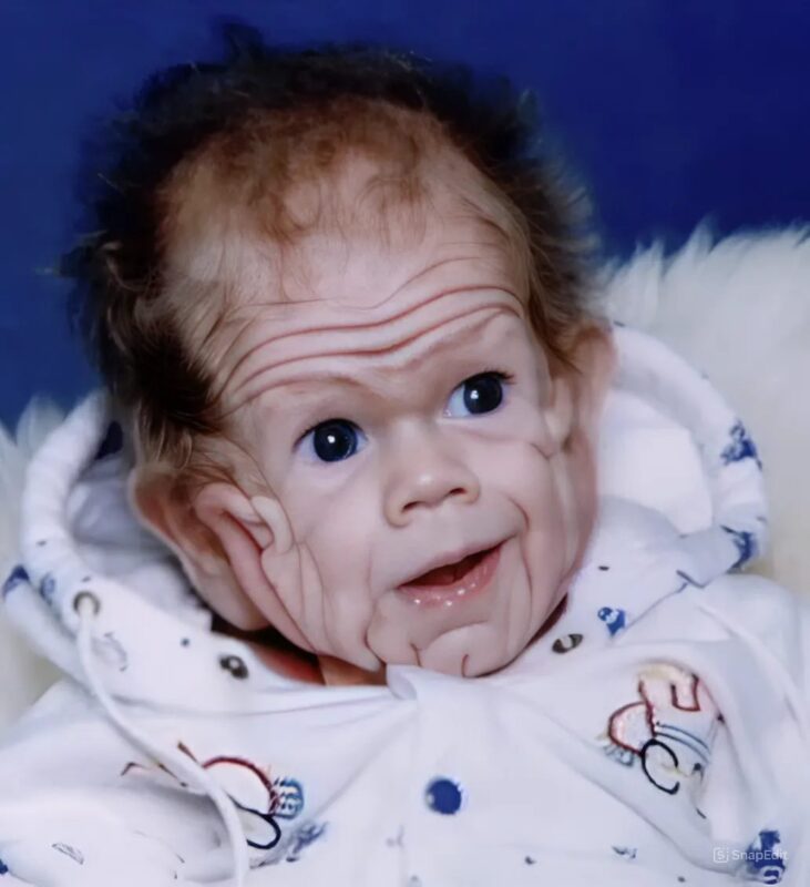 Ce garçon est né en 1993 avec une peau plissée comme celle d'un enfant de 5 ans