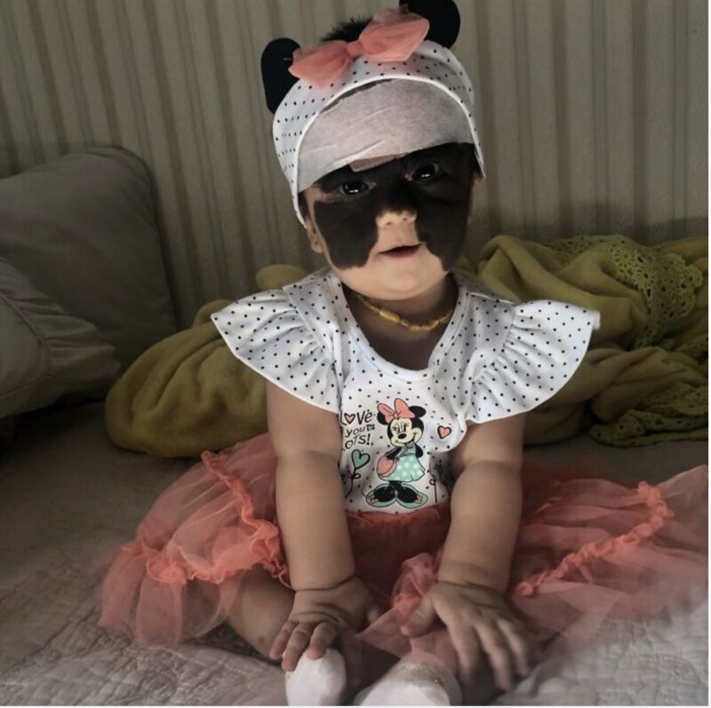 « La fille Batman a grandi » : Découvrez cette jeune fille née avec un "masque"