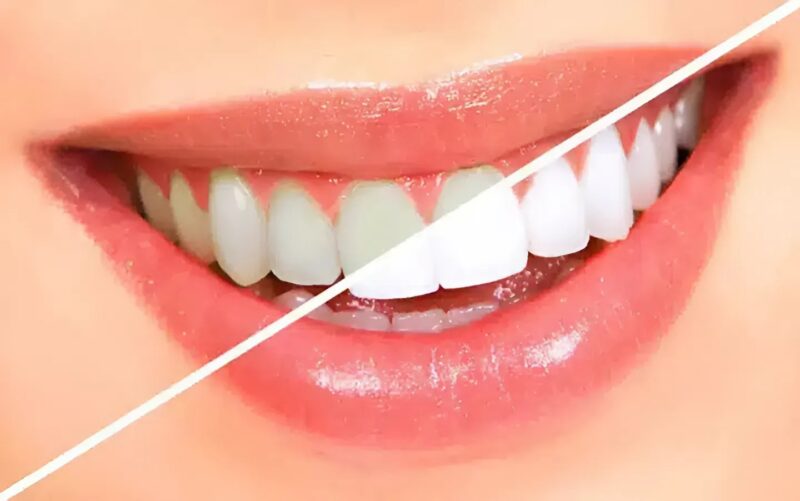 L’astuce méconnue à base de riz pour des dents plus blanches en un rien de temps !
