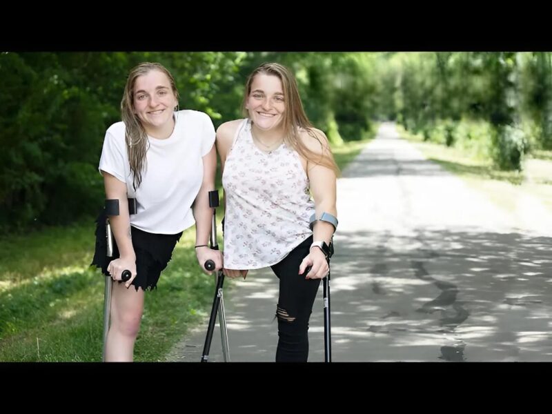 Trois sœurs nées triplées, dont deux siamoises, abandonnées à la naissance… Regardez-les 18 ans plus tard
